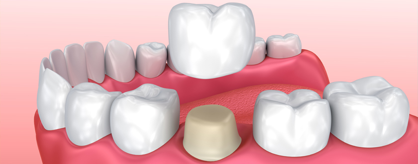 Photo of a model of a crown being placed over a tooth