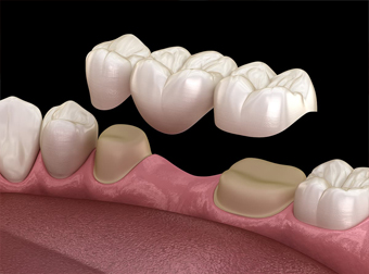 Photo of a model of a bridge being placed over two teeth