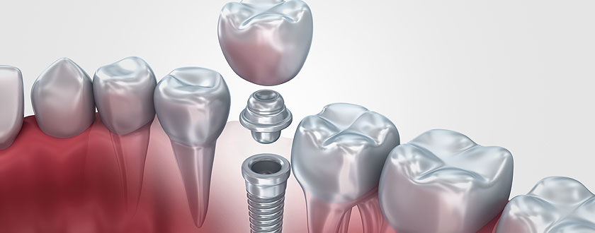 Dental Implant image of tooth being placed